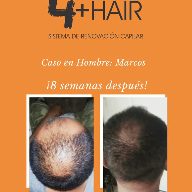 4+Hair Sistema de Renovación Capilar