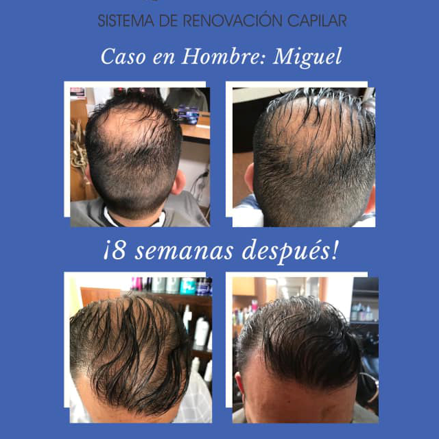 4+Hair Sistema de Renovación Capilar